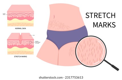 Body cellulite of overweight leg women female and stretch marks or gain loss muscle the stomach chemical peel in Laser therapy loose with Cushing's steroid removal