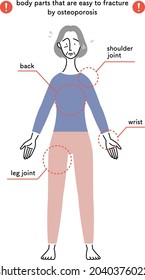 body parts that are easy to fracture by osteoporosis