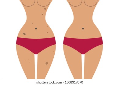 Body pigmentation, woman with hyperpigmentation of skin, laser removal of keratosis and age spots before and after. Vector illustration