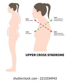 body poor and Postural anterior pelvic tilt upper cross syndrome trapezius of dowager’s painful spinal with Scheuermann's rounded Disk care