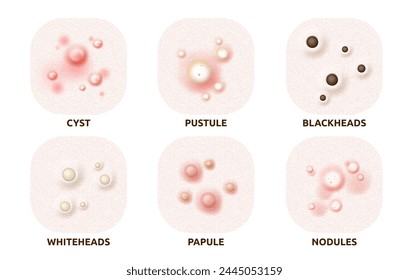 Body skin acne type blackheads, whiteheads, papule, pustule, cyst and nodules. Realistic 3d vector skin disease caused by excess oil production, bacteria, and inflammation, hormonal changes or sweat