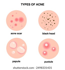 Body skin acne type blackheads, whiteheads, papule, pustule, cyst and nodules. a cartoon illustration vector skin conditions characterized by inflamed sebaceous glands, leading to pimples on face or 