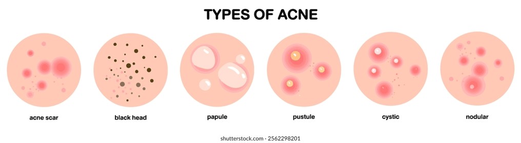 Body skin acne type blackheads, whiteheads, papule, pustule, cyst , cystic and nodules. a cartoon illustration vector skin conditions characterized by inflamed sebaceous