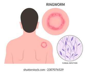 concepto médico de infección por gusano de anillo en el hombro con síntoma de picor en la piel