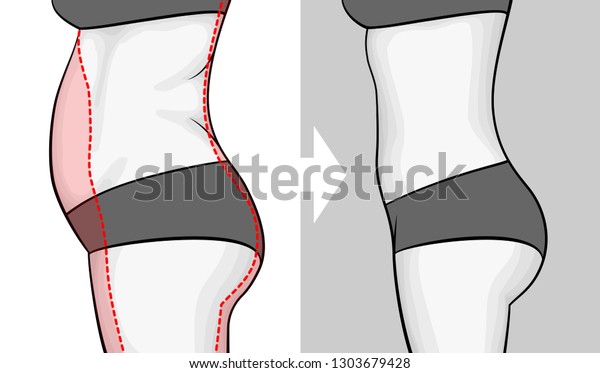 体重が減る前後の女性の体 横から見た腹 余分な重みを示す赤い輪郭 のベクター画像素材 ロイヤリティフリー