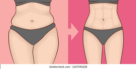 El cuerpo de una mujer antes y después de la pérdida de peso en ropa interior. Prensa y cadera.