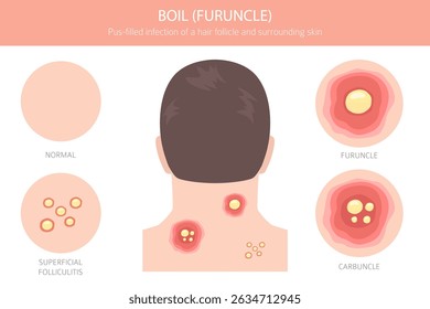 Boil, Furuncle, carbuncle. Skin diseases. Medical infographic design. Vector illustration