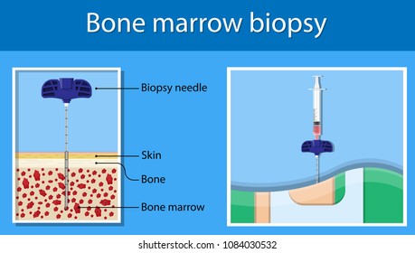 biopsy marrow procedure specimen