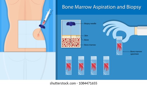 biopsy marrow