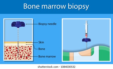 Bone Biopsy Medical Marrow Harvest Stem Cell Transplants Aspiration Specimen Cancer Procedure Sample Test Treatment Diagnosis Anemia Blood Cell Lab