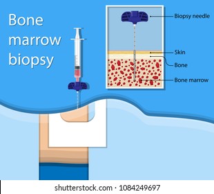 19 Bone marrow fibrosis Images, Stock Photos & Vectors | Shutterstock