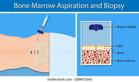 Bone biopsy medical marrow harvest stem cell transplants aspiration specimen cancer procedure sample test treatment diagnosis anemia blood cell lab