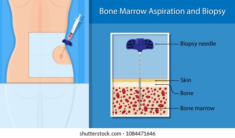 Bone Biopsy Medical Marrow Harvest Stem Stock Vector (Royalty Free ...