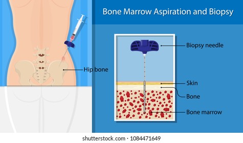 Bone Biopsy Medical Marrow Harvest Stem Cell Transplants Aspiration Specimen Cancer Procedure Sample Test Treatment Diagnosis Anemia Blood Cell Lab