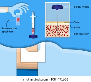 Bone Biopsy Medical Marrow Harvest Stem Cell Transplants Aspiration Specimen Cancer Procedure Sample Test Treatment Diagnosis Anemia Blood Cell Lab