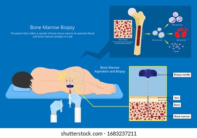 Bone biopsy medical marrow harvest stem cell transplants aspiration specimen cancer procedure sample test treatment diagnosis anemia blood cell lab