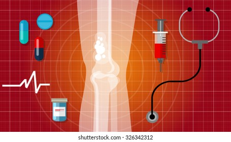 bone cancer medication anatomy medical health care cure 