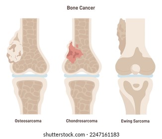 Bone cancer types set. Ewing's sarcoma, osteosarcoma and chondrosarcoma. Tumor cells with tissues mutation and inflammation. Flat vector illustration