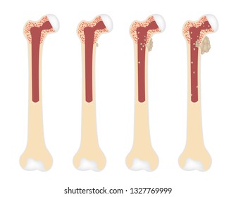 Bone Cancer Vector Stages / Tumor