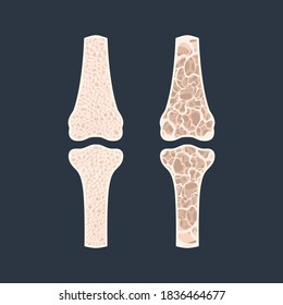 Bone density loss disease infographic banner. Normal bone vs osteoporotic bone. Health care and medical concept. Vector illustration.