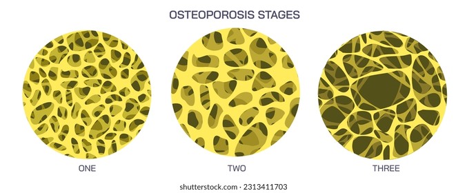 Mediciones de la densidad ósea y etapas de la osteoporosis. Enfermedad ósea que se desarrolla cuando disminuye la densidad mineral ósea y la masa ósea, o cambia la calidad o estructura. ilustración vectorial.