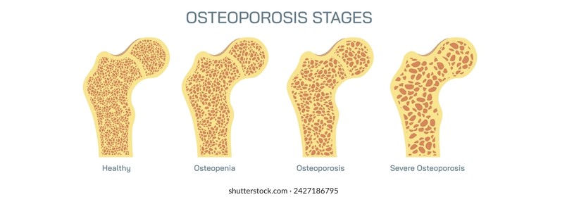 Bone density measurements and stages of osteoporosis. A bone disease that develops when bone mineral density and bone mass decreases, or the quality or structure  changes. vector illustration.