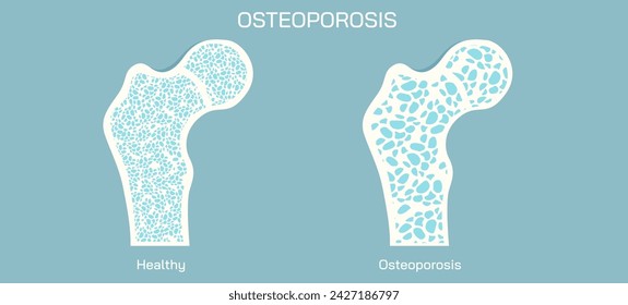 Bone density measurements and stages of osteoporosis. A bone disease that develops when bone mineral density and bone mass decreases, or the quality or structure  changes. vector illustration.