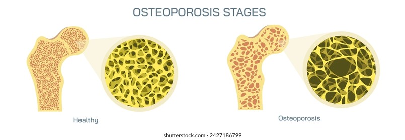 Bone density measurements and stages of osteoporosis. A bone disease that develops when bone mineral density and bone mass decreases, or the quality or structure  changes. vector illustration.