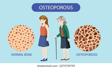 Ilustración del vector de densidad ósea y osteoporosis