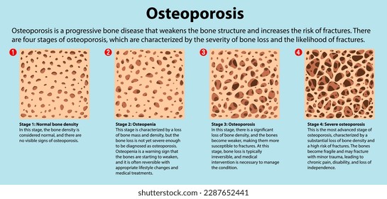 Bone Density and Osteoporosis Vector illustration