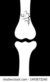 Bone fracture - cracks and deterioration of skeleton - injury and disease. Vector illustration. 