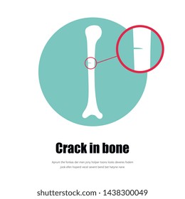 Bone fracture Type of fracture. Vector fracture icon.Detailed view of the fracture
