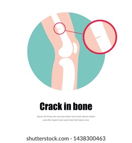 Bone fracture Type of fracture. Vector fracture icon.Detailed view of the fracture