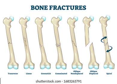 Bone Fractures Vector Illustration Educational Labeled Stock Vector ...