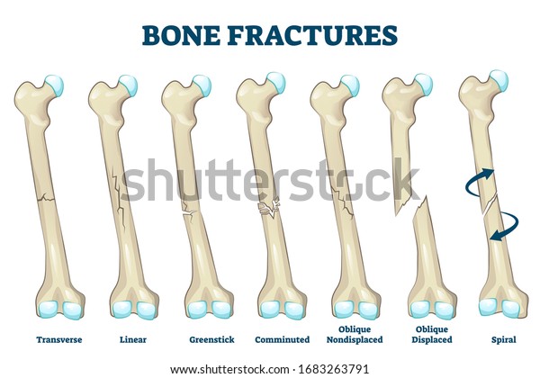 Bone Fractures Vector Illustration Educational Labeled Stock Vector Royalty Free 1683263791 0555