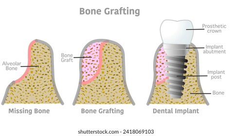 Bone grafting implant steps anatomy, teeth structure. Dental, tooth diagram. Bone titanium screw post, prosthetic crown, abutment, gum. Medical, periodontal. Vector illustration