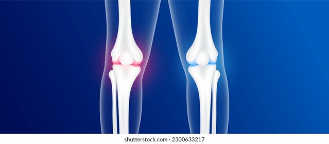 Bone healthy and osteoarthritis or degenerative joint disease. Arthritis knee joint pain within a leg. Cartilage becomes worn. This results in inflammation swelling. Human bone anatomy. Vector EPS10.