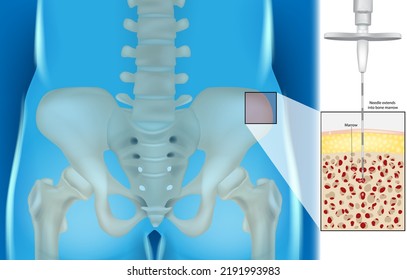 Bone Marrow Aspiration And Biopsy. Illustration Of The Needle Extends Into Bone Marrow. Hematology