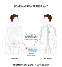 Bone Marrow Transplant. Men Silhouettes (recipient And Donor) With Highlighted Of The Skeleton And Blood Vessel. Transfusing Healthy Stem Cells From Donor To A Recipient's Blood Stream 