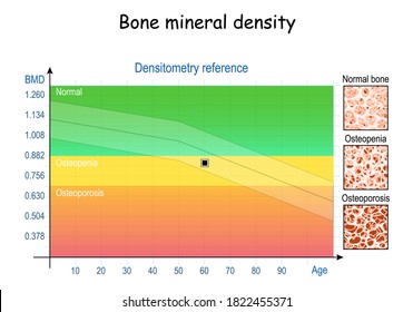 Bone mineral density (BMD). Densitometry reference (chart). close-up of condition of bone tissue from healthy to Osteopenia and osteoporosis. Aging process. vector illustration