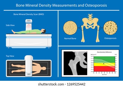 Bone mineral density (BMD) osteoporosis dual energy X-ray absorptionmetry adult disease equipment medical clinic central DXA pain radiography hospital fragility risk examine