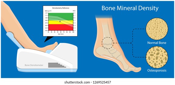 Bone mineral density (BMD) osteoporosis dual energy X-ray absorptionmetry adult disease equipment medical clinic central DXA pain radiography hospital fragility risk examine