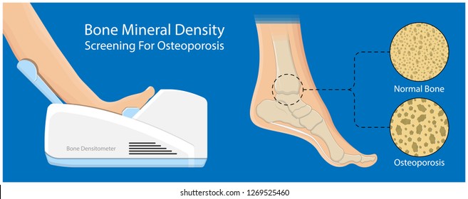 Bone mineral density (BMD) osteoporosis dual energy X-ray absorptionmetry adult disease equipment medical clinic central DXA pain radiography hospital fragility risk examine