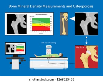 Bone mineral density (BMD) osteoporosis dual energy X-ray absorptionmetry adult disease equipment medical clinic central DXA pain radiography hospital fragility risk examine