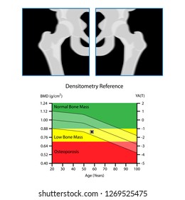 Bone mineral density (BMD) osteoporosis dual energy X-ray absorptionmetry adult disease equipment medical clinic central DXA pain radiography hospital fragility risk examine