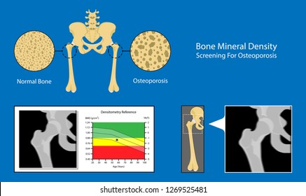 Bone mineral