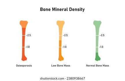 Bone Mineral Density Level Concept Design. Vector Illustration.	