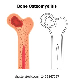 Bone Osteomyelitis Science Design Vector Ilustration Diagram