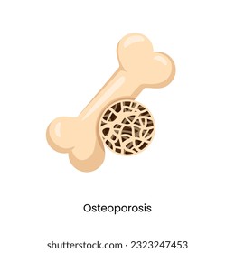 osteoporosis ósea problema de salud enfermedad médica esponja anatomía artritis