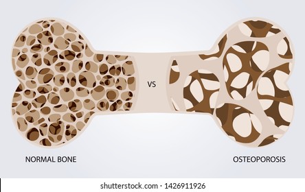 Bone with osteoporosis, normal bone versus osteoporosis illustration